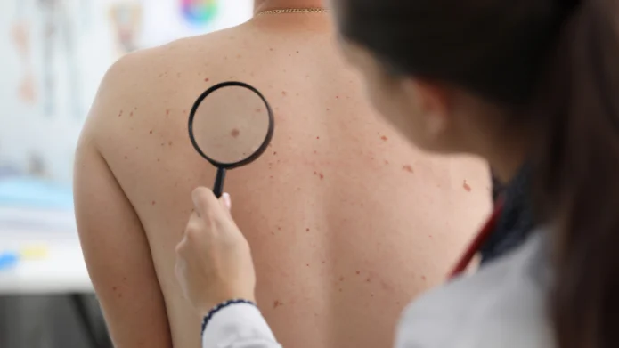 Hautkrebs Screening ab 60 Hautkrebs Screening ab 60: Eine Ärztin betrachtet durch eine Lupe ein auffälliges Pigmentmal auf dem Rücken eines Patienten.